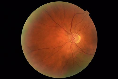 Coats Disease - Parafoveal Telangiectasis Type I - Right Eye
67 year old man with long history of vision loss in the right eye.  Previously treated with laser, avastin.  VA 20/200.
