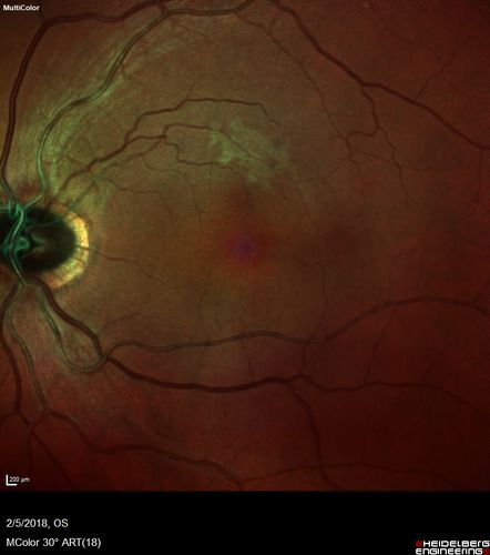 Coats Disease - Parafoveal Telangiectasis Type I - Right Eye
67 year old man with long history of vision loss in the right eye.  Previously treated with laser, avastin.  VA 20/200.
