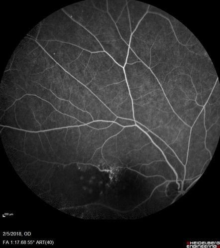 Coats Disease - Parafoveal Telangiectasis Type I - Right Eye
67 year old man with long history of vision loss in the right eye.  Previously treated with laser, avastin.  VA 20/200.
