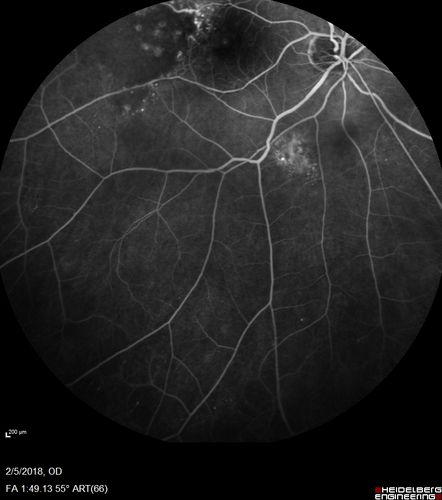 Coats Disease - Parafoveal Telangiectasis Type I - Right Eye
67 year old man with long history of vision loss in the right eye.  Previously treated with laser, avastin.  VA 20/200.
