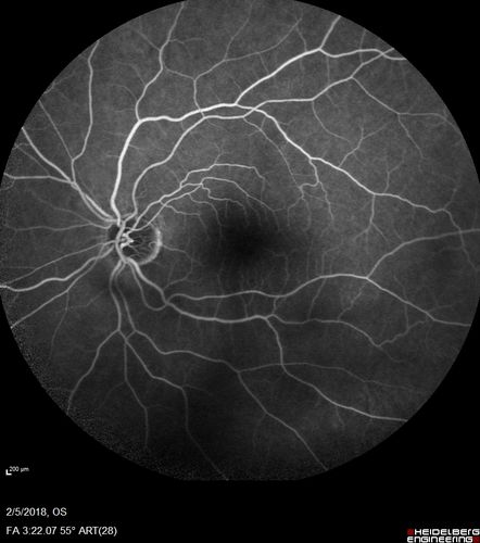 Coats Disease - Parafoveal Telangiectasis Type I - Right Eye
67 year old man with long history of vision loss in the right eye.  Previously treated with laser, avastin.  VA 20/200.
