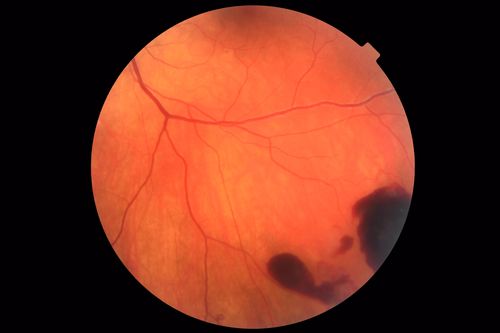 Coats' Disease -51 year old asymptomatic male
20/20 vision - had laser to non-perfusion because of proliferation.
