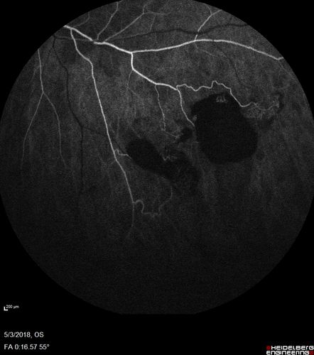 Coats' Disease -51 year old asymptomatic male
20/20 vision - had laser to non-perfusion because of proliferation.
