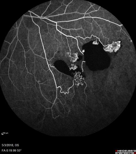 Coats' Disease -51 year old asymptomatic male
20/20 vision - had laser to non-perfusion because of proliferation.
