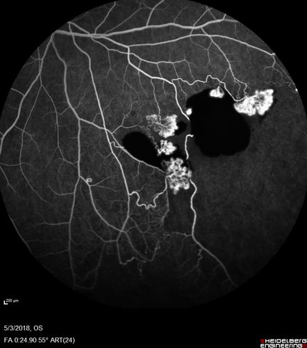 Coats' Disease -51 year old asymptomatic male
20/20 vision - had laser to non-perfusion because of proliferation.
