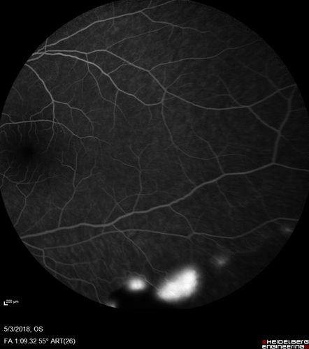 Coats' Disease -51 year old asymptomatic male
20/20 vision - had laser to non-perfusion because of proliferation.
