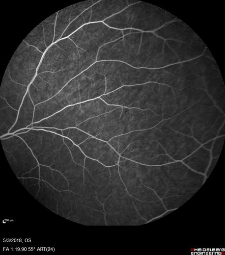 Coats' Disease -51 year old asymptomatic male
20/20 vision - had laser to non-perfusion because of proliferation.
