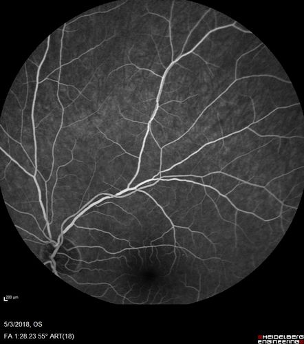 Coats' Disease -51 year old asymptomatic male
20/20 vision - had laser to non-perfusion because of proliferation.
