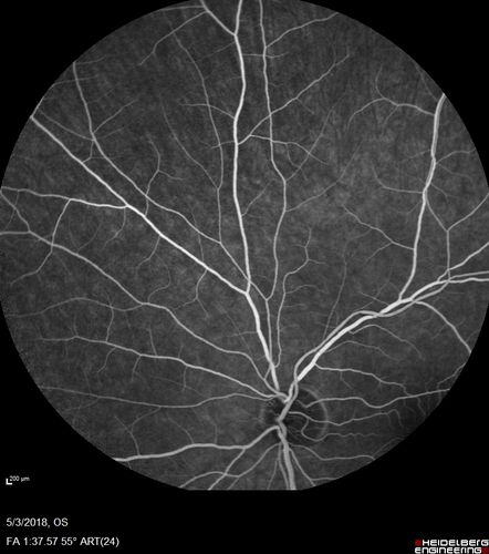 Coats' Disease -51 year old asymptomatic male
20/20 vision - had laser to non-perfusion because of proliferation.
