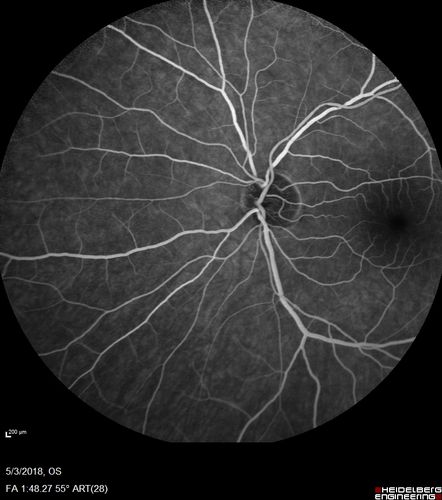 Coats' Disease -51 year old asymptomatic male
20/20 vision - had laser to non-perfusion because of proliferation.
