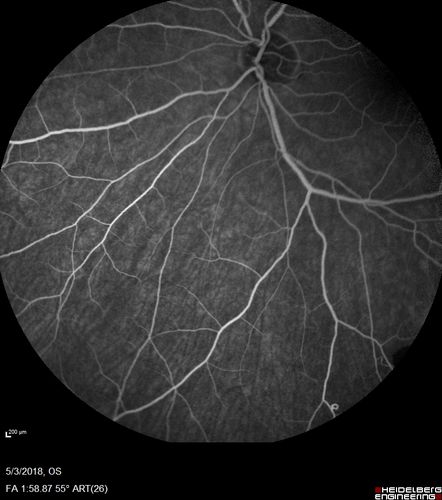 Coats' Disease -51 year old asymptomatic male
20/20 vision - had laser to non-perfusion because of proliferation.
