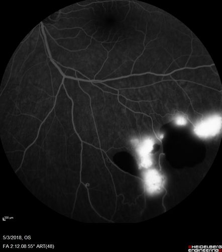 Coats' Disease -51 year old asymptomatic male
20/20 vision - had laser to non-perfusion because of proliferation.
