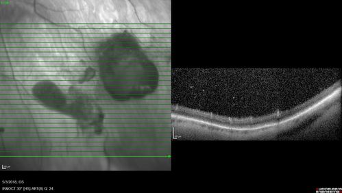 Coats' Disease -51 year old asymptomatic male
20/20 vision - had laser to non-perfusion because of proliferation.
