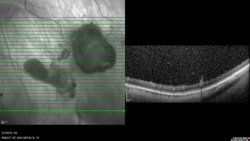 Coats' Disease -51 year old asymptomatic male
20/20 vision - had laser to non-perfusion because of proliferation.
