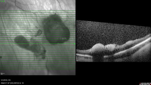 Coats' Disease -51 year old asymptomatic male
20/20 vision - had laser to non-perfusion because of proliferation.
