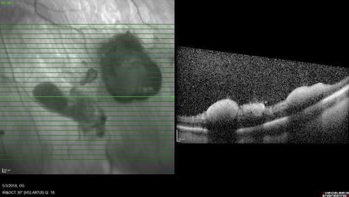 Coats' Disease -51 year old asymptomatic male
20/20 vision - had laser to non-perfusion because of proliferation.
