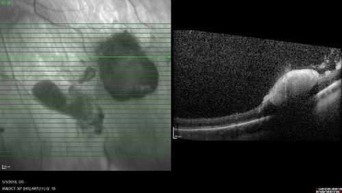 Coats' Disease -51 year old asymptomatic male
20/20 vision - had laser to non-perfusion because of proliferation.
