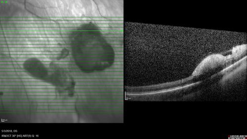 Coats' Disease -51 year old asymptomatic male
20/20 vision - had laser to non-perfusion because of proliferation.
