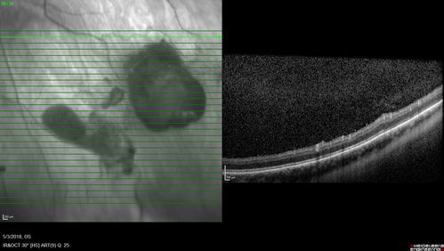 Coats' Disease -51 year old asymptomatic male
20/20 vision - had laser to non-perfusion because of proliferation.
