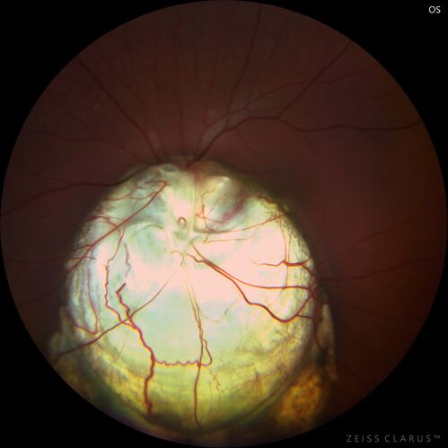 Coloboma - Iris, Lens, Chorioretinal
15 year old with poor vision since birth.  Noticing new flashes in the left eye.  There is an iris - lens coloboma as well.
