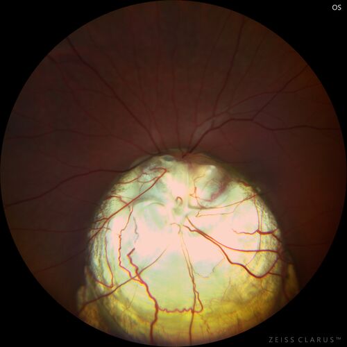 Coloboma - Iris, Lens, Chorioretinal
15 year old with poor vision since birth.  Noticing new flashes in the left eye.  There is an iris - lens coloboma as well.

