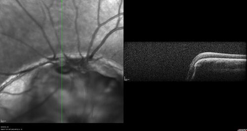 Coloboma - Iris, Lens, Chorioretinal
15 year old with poor vision since birth.  Noticing new flashes in the left eye.  There is an iris - lens coloboma as well.
