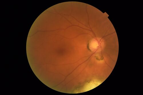 Coloboma - Non Macular - Left Eye
71 year old female with cataracts.  Left eye has inferior coloboma.
