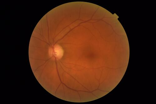 Coloboma - Non Macular - Left Eye
71 year old female with cataracts.  Left eye has inferior coloboma.
