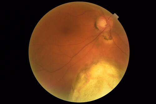 Coloboma - Non Macular - Left Eye
71 year old female with cataracts.  Left eye has inferior coloboma.
