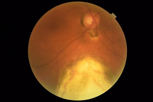 Coloboma - Non Macular - Left Eye
71 year old female with cataracts.  Left eye has inferior coloboma.
