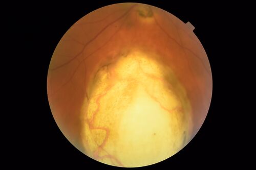Coloboma - Non Macular - Left Eye
71 year old female with cataracts.  Left eye has inferior coloboma.
