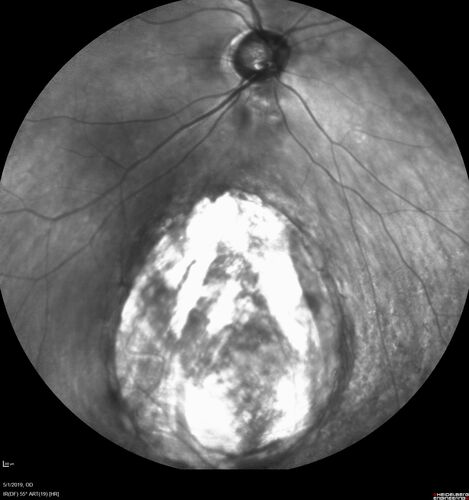 Coloboma - Non Macular - Left Eye
71 year old female with cataracts.  Left eye has inferior coloboma.
