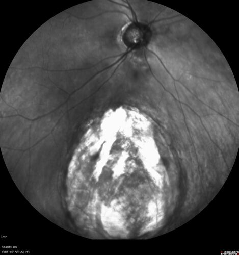 Coloboma - Non Macular - Left Eye
71 year old female with cataracts.  Left eye has inferior coloboma.
