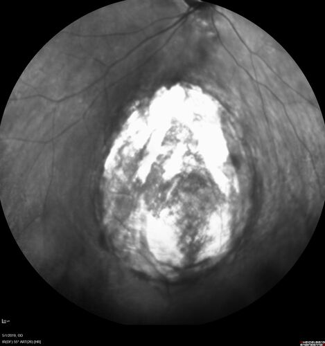 Coloboma - Non Macular - Left Eye
71 year old female with cataracts.  Left eye has inferior coloboma.
