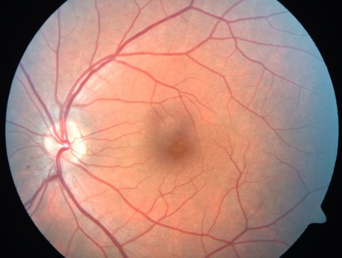 Commotio Retinae - One Day following Basketball to Eye
43-year-old man was playing basketball last night.  He was hit straight in the left eye with the ball.  Initially he had darkness in his inferior vision and now he has darkness inferonasally in the left eye. 
 Vision OD is 20/16, vision OS is 20/32
