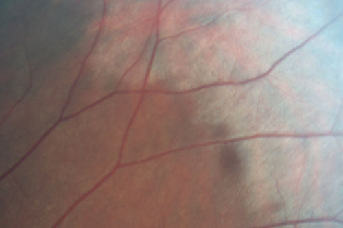Commotio Retinae - One Day following Basketball to Eye
43-year-old man was playing basketball last night.  He was hit straight in the left eye with the ball.  Initially he had darkness in his inferior vision and now he has darkness inferonasally in the left eye. 
 Vision OD is 20/16, vision OS is 20/32
