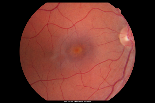 Congenital Achromatopsia 
26-year-old man was diagnosed with congenital achromatopsia by ERG as a child.  He has family members who also have this disorder.   OD 20/200, OS 20/200.
