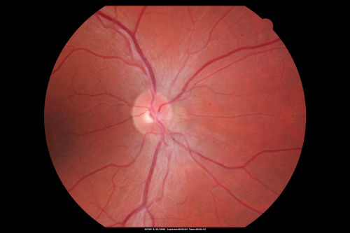 Congenital Achromatopsia 
26-year-old man was diagnosed with congenital achromatopsia by ERG as a child.  He has family members who also have this disorder.   OD 20/200, OS 20/200.
