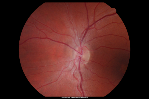 Congenital Achromatopsia 
26-year-old man was diagnosed with congenital achromatopsia by ERG as a child.  He has family members who also have this disorder.   OD 20/200, OS 20/200.
