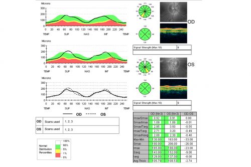 Congenital Achromatopsia 
26-year-old man was diagnosed with congenital achromatopsia by ERG as a child.  He has family members who also have this disorder.   OD 20/200, OS 20/200.
