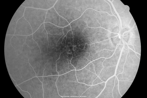 Congenital Achromatopsia 
26-year-old man was diagnosed with congenital achromatopsia by ERG as a child.  He has family members who also have this disorder.   OD 20/200, OS 20/200.
