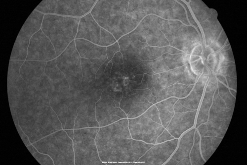 Congenital Achromatopsia 
26-year-old man was diagnosed with congenital achromatopsia by ERG as a child.  He has family members who also have this disorder.   OD 20/200, OS 20/200.
