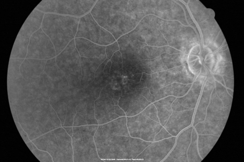 Congenital Achromatopsia 
26-year-old man was diagnosed with congenital achromatopsia by ERG as a child.  He has family members who also have this disorder.   OD 20/200, OS 20/200.
