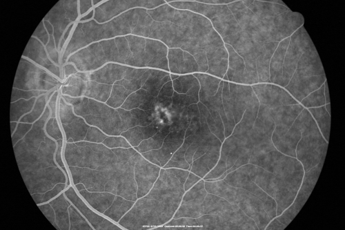 Congenital Achromatopsia 
26-year-old man was diagnosed with congenital achromatopsia by ERG as a child.  He has family members who also have this disorder.   OD 20/200, OS 20/200.
