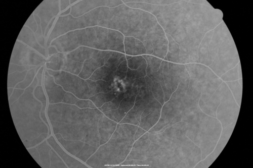 Congenital Achromatopsia 
26-year-old man was diagnosed with congenital achromatopsia by ERG as a child.  He has family members who also have this disorder.   OD 20/200, OS 20/200.
