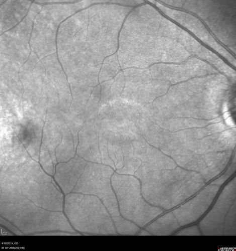 Late Onset Cone Dystrophy - Very Mild
Only IR and OCT show very mild bull's eye.  67 year old female with difficulty seeing in bright light
