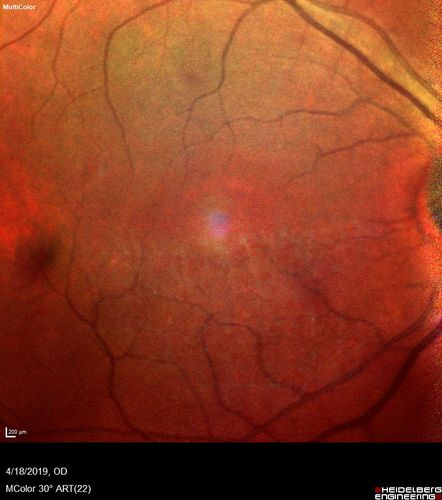 Late Onset Cone Dystrophy - Very Mild
Only IR and OCT show very mild bull's eye.  67 year old female with difficulty seeing in bright light
