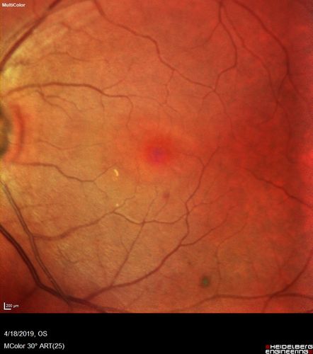 Late Onset Cone Dystrophy - Very Mild
Only IR and OCT show very mild bull's eye.  67 year old female with difficulty seeing in bright light
