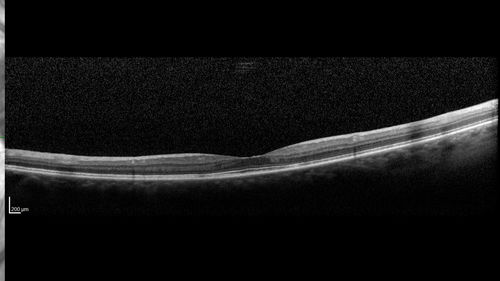 Late Onset Cone Dystrophy - Very Mild
Only IR and OCT show very mild bull's eye.  67 year old female with difficulty seeing in bright light
