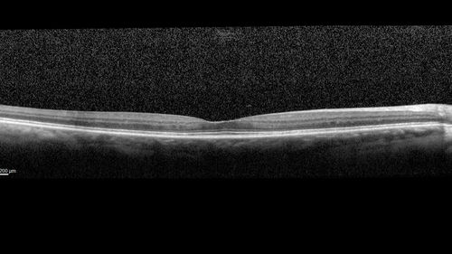 Late Onset Cone Dystrophy - Very Mild
Only IR and OCT show very mild bull's eye.  67 year old female with difficulty seeing in bright light
